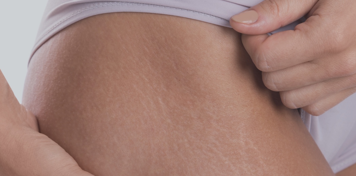 PSI stretch marks blog featured