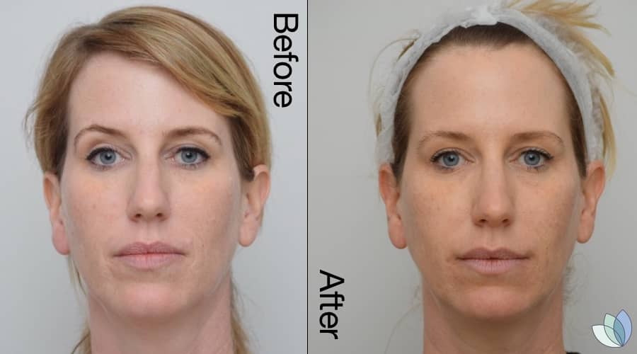 precision skin institute before after fillers 2