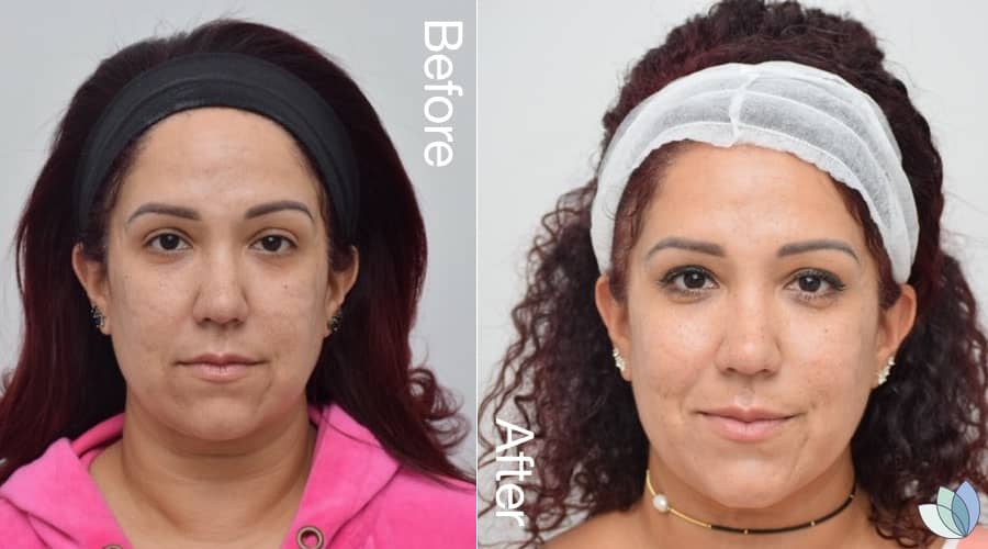 precision skin institute before after exceed microneedling 1