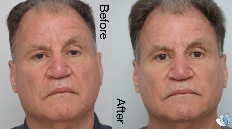 precision skin institute before after gentlemax 3