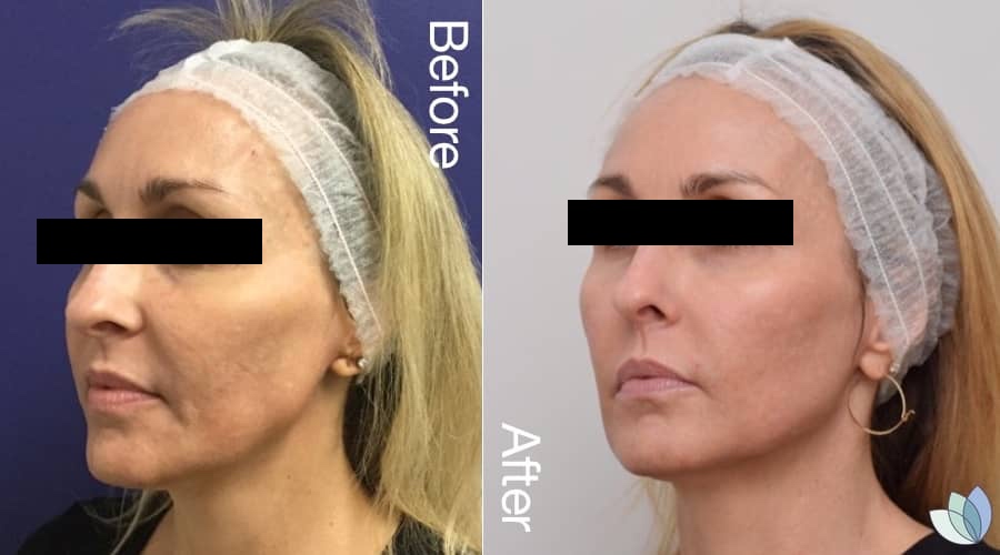 precision-skin-institute-before-after-picoway